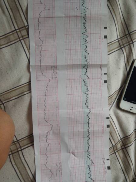 假性宫缩多久才会生