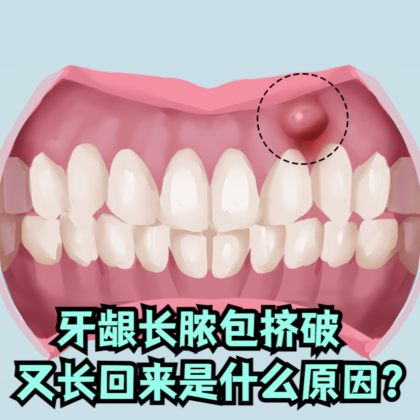 牙龈上长了个脓包怎么回事