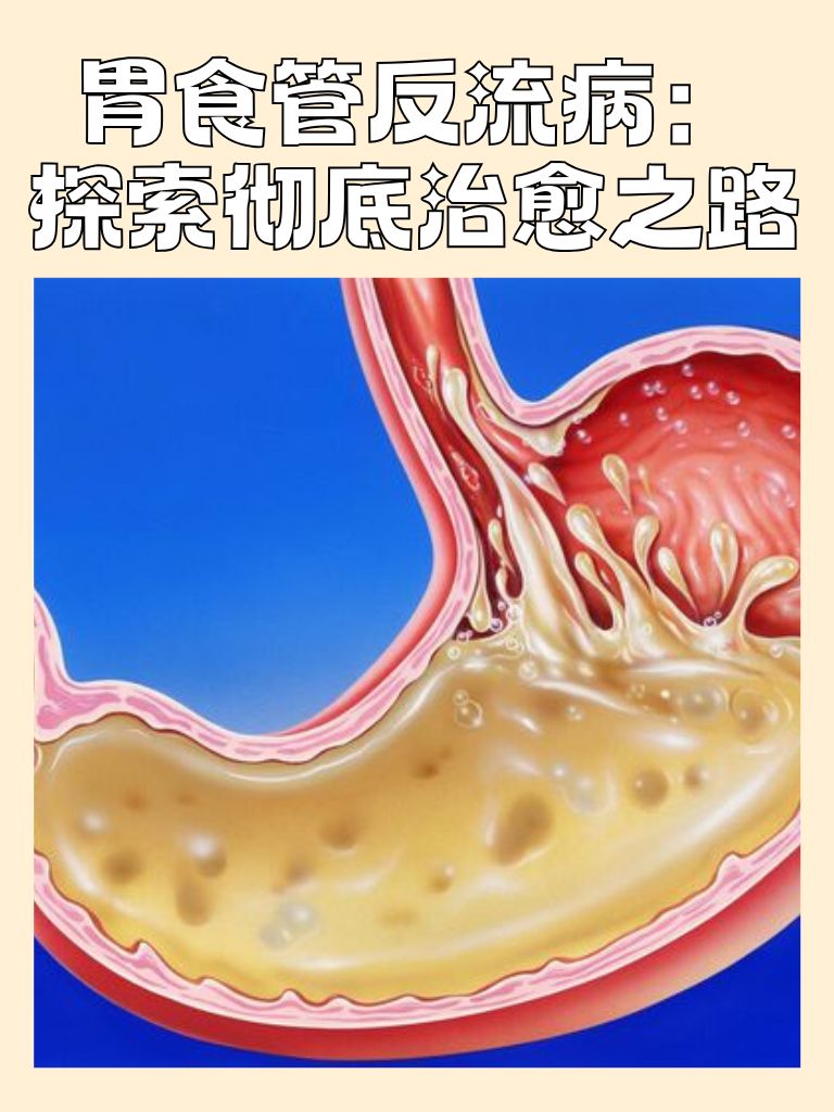 胃食管反流病能治好吗?