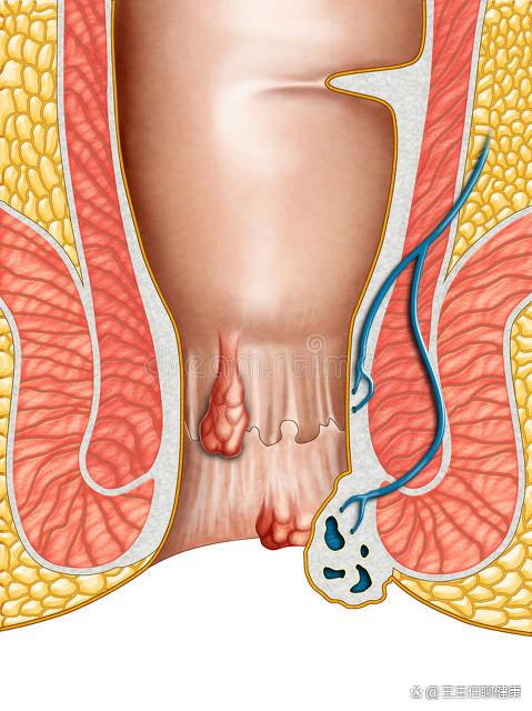 肛门癌的表现主要是什么?