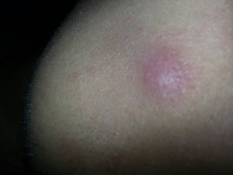 脸上长了个肉疙瘩,怎么治?