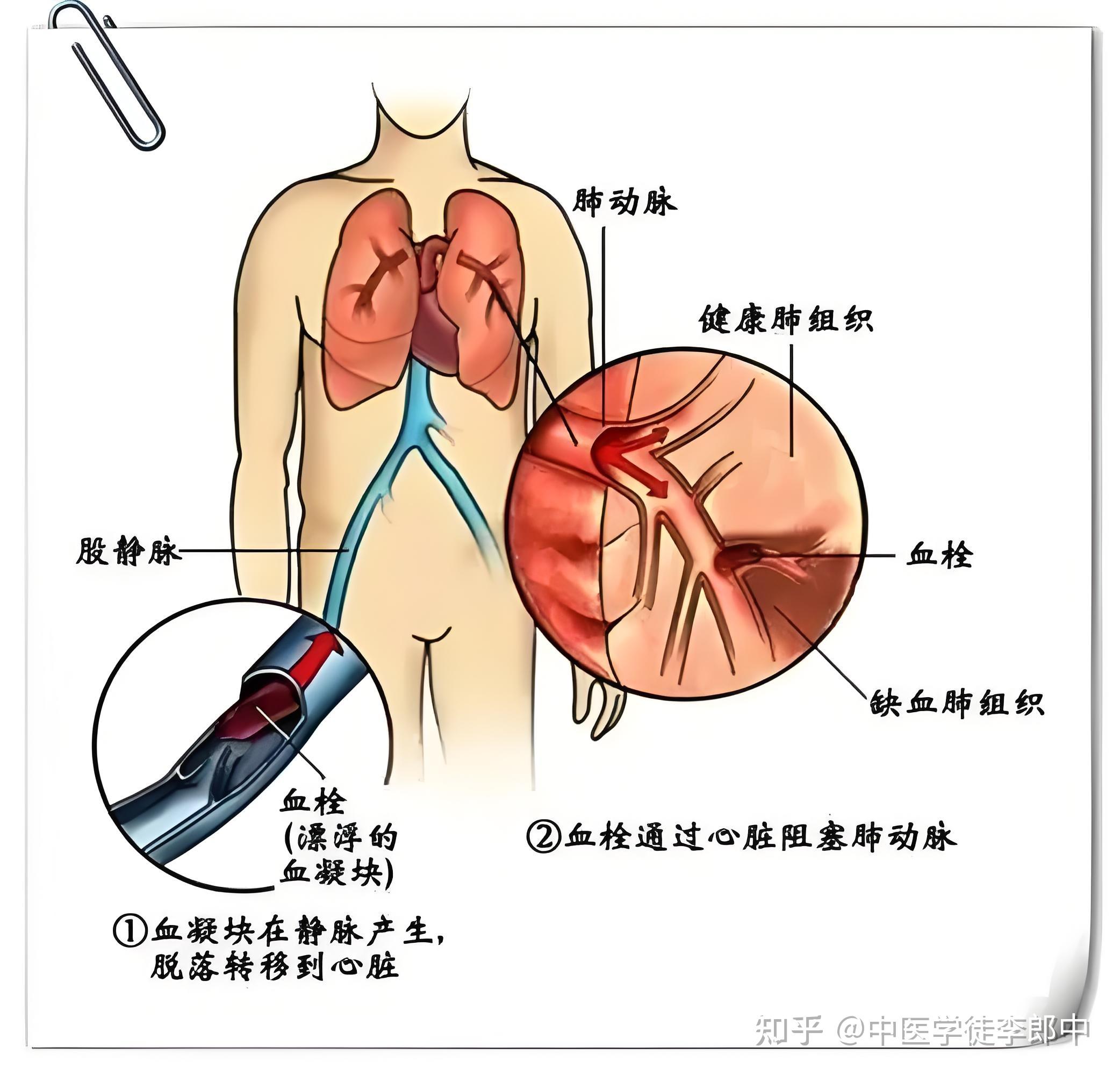 空气栓塞的症状是什么