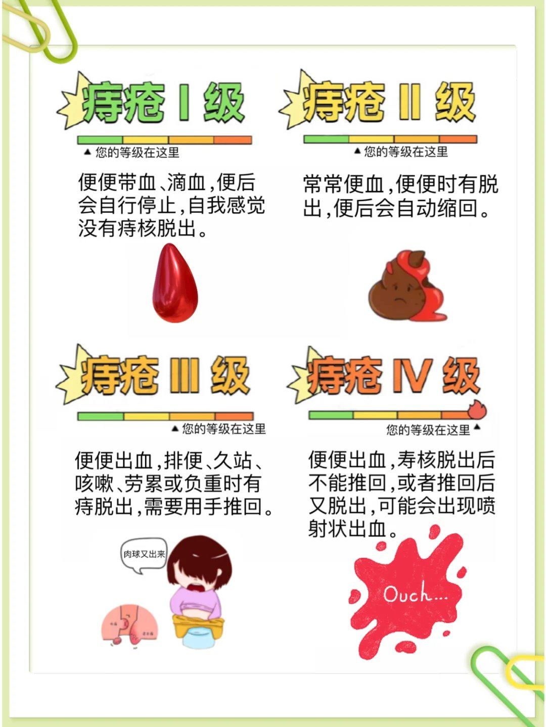 内痔的临床分期