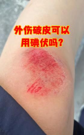 碘伏可以涂在伤口上吗