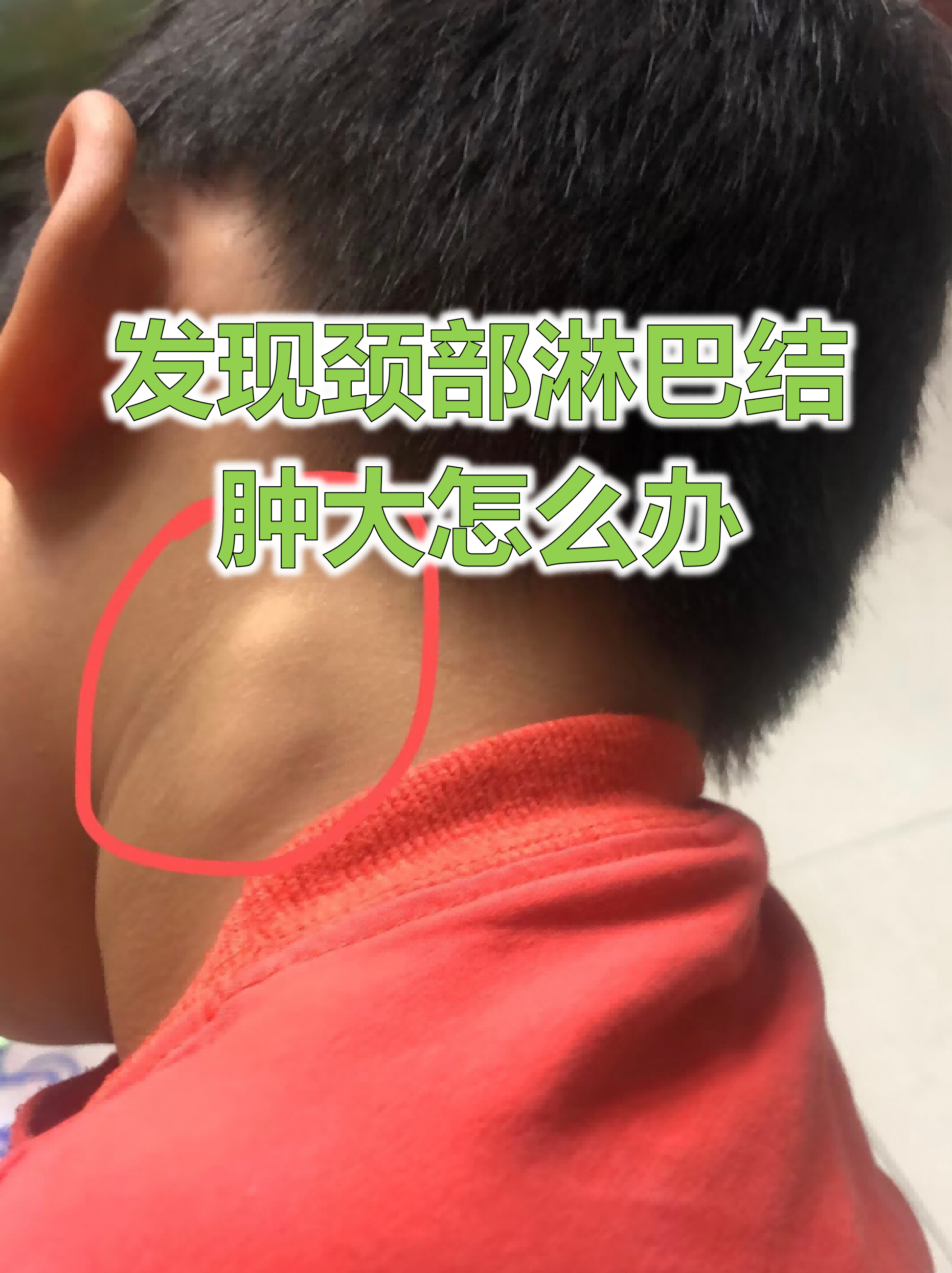 淋巴发炎怎么办