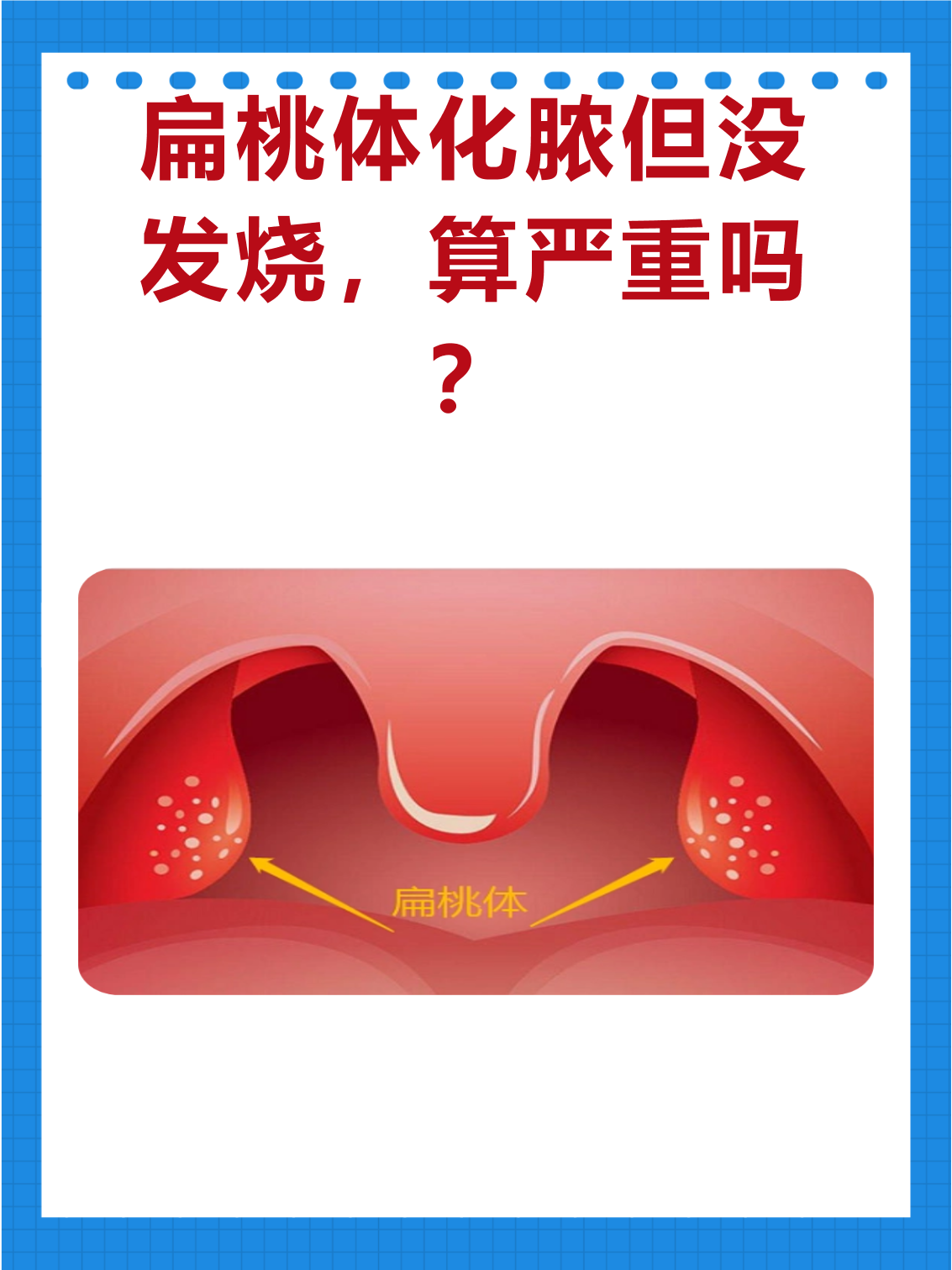 扁桃体发炎会引起发烧吗