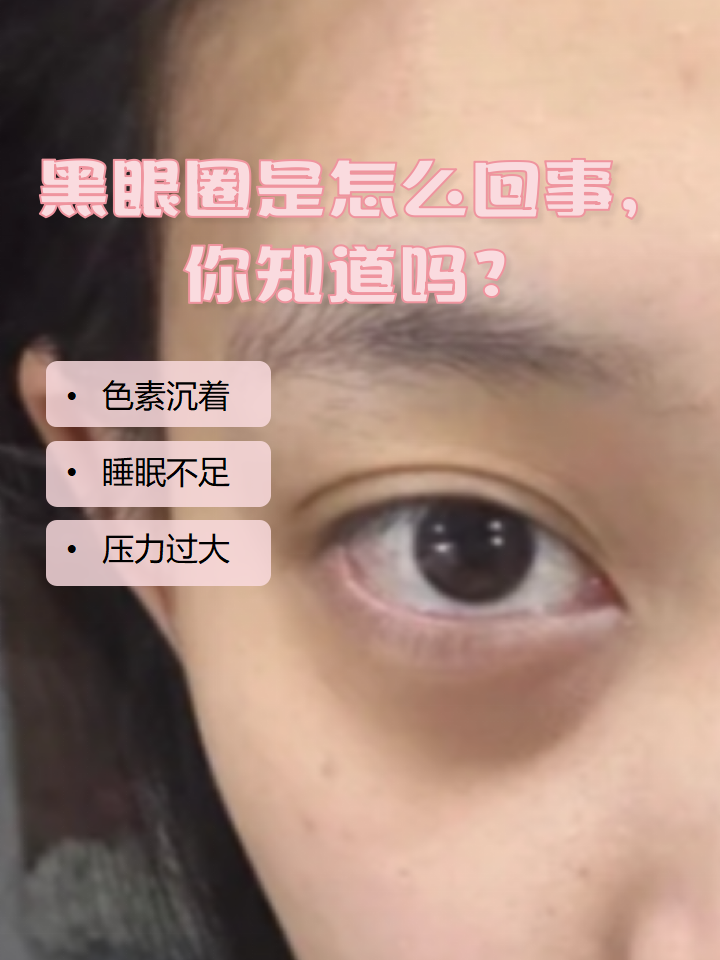 黑眼圈很严重是什么原因?