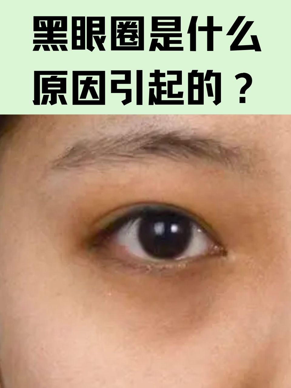 黑眼圈很严重是什么原因?