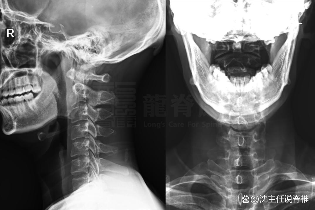 交感神经型颈椎病症状