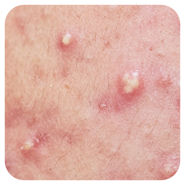 阴囊位置长了一些肉粒