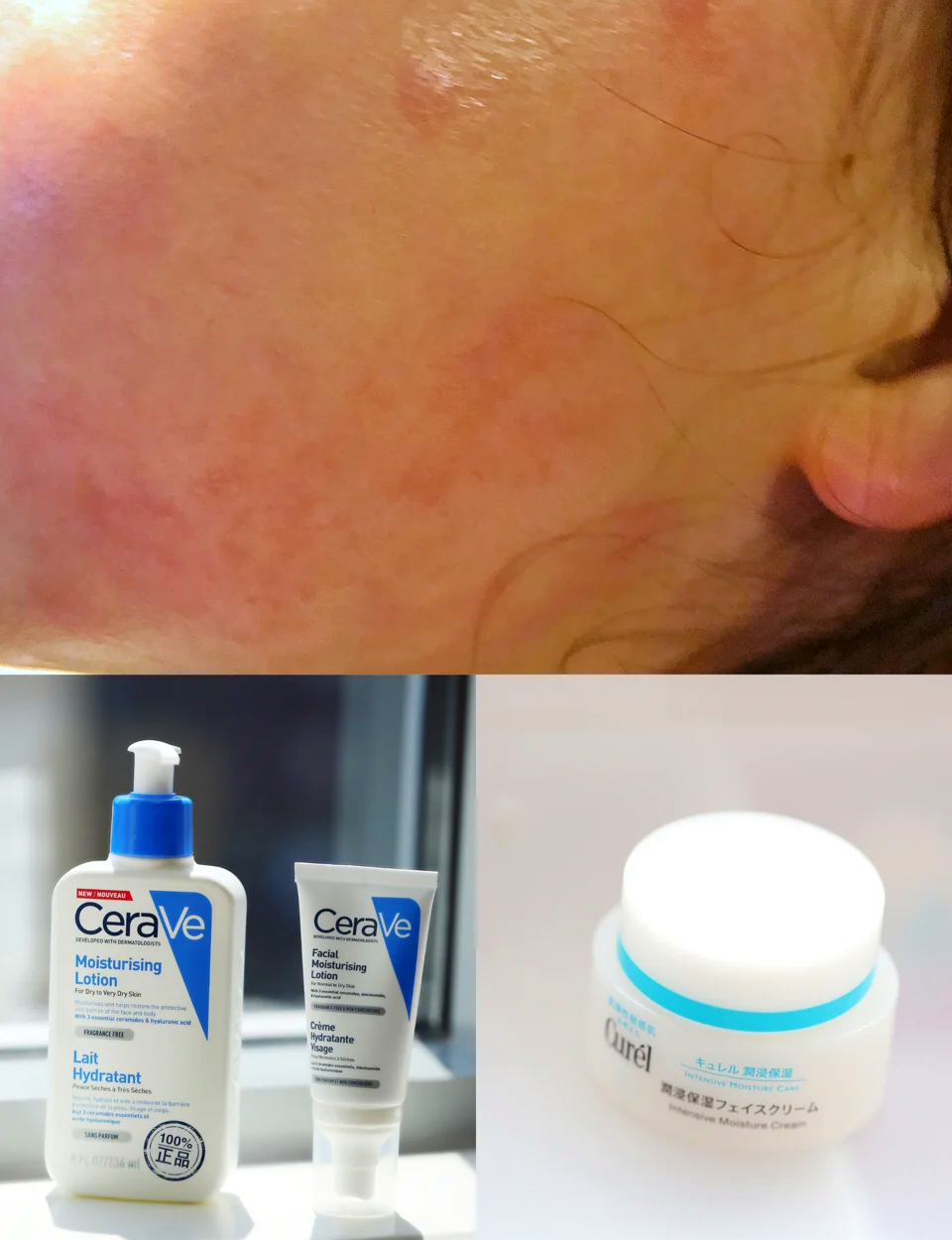 脸部晒伤后怎么办