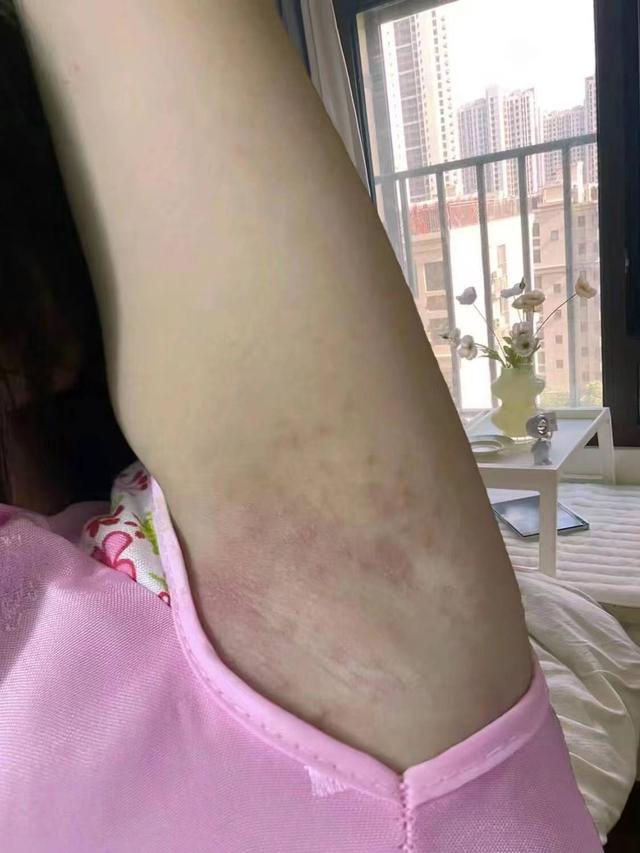 腋窝脱毛有什么危害