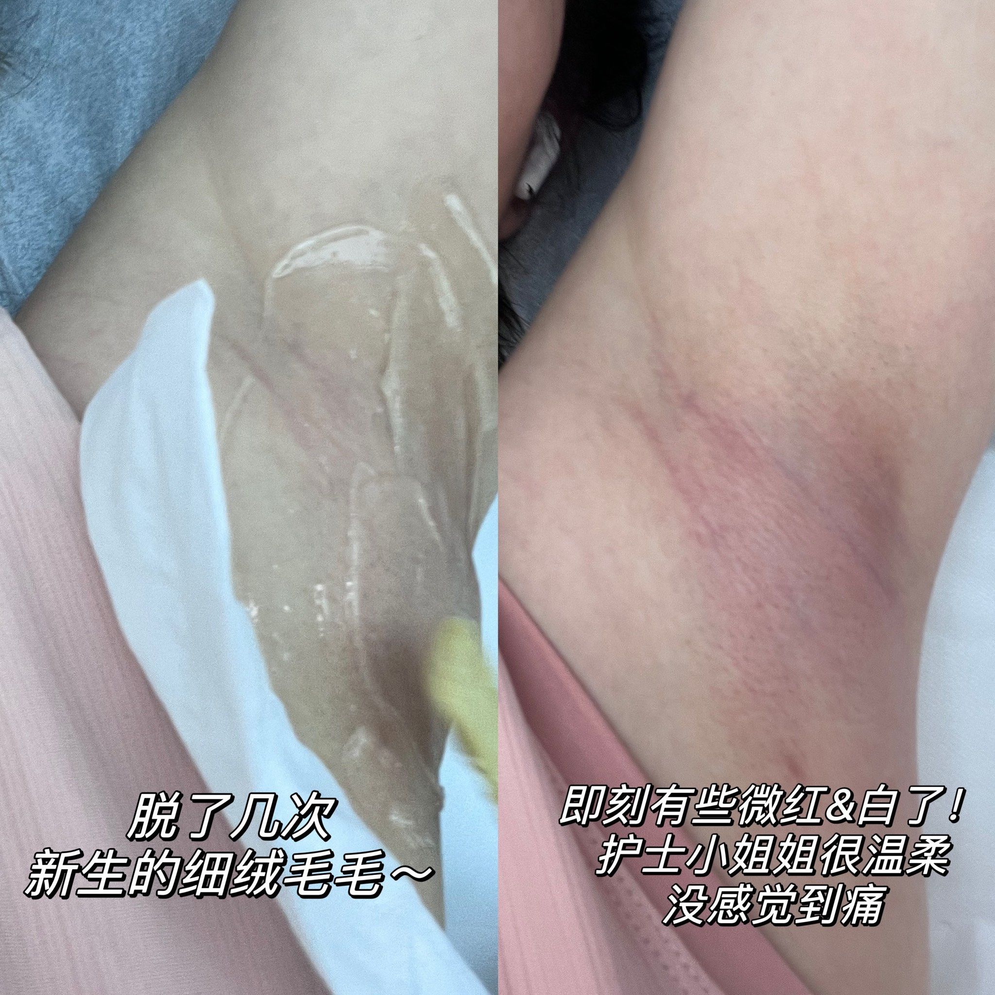 腋窝脱毛有什么危害