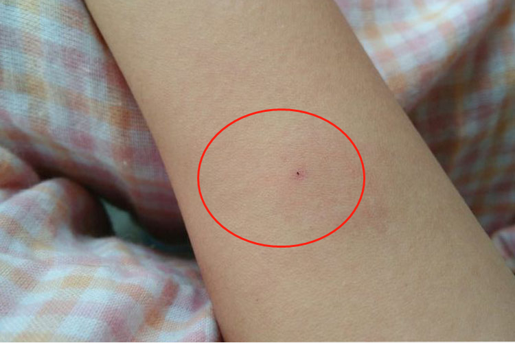 结核皮试怎样是正常的