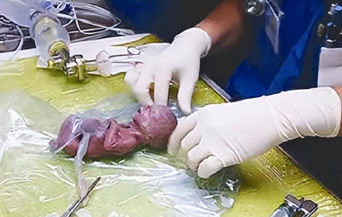 我是7月27号做的引产宝宝在肚子6个月了28号照的