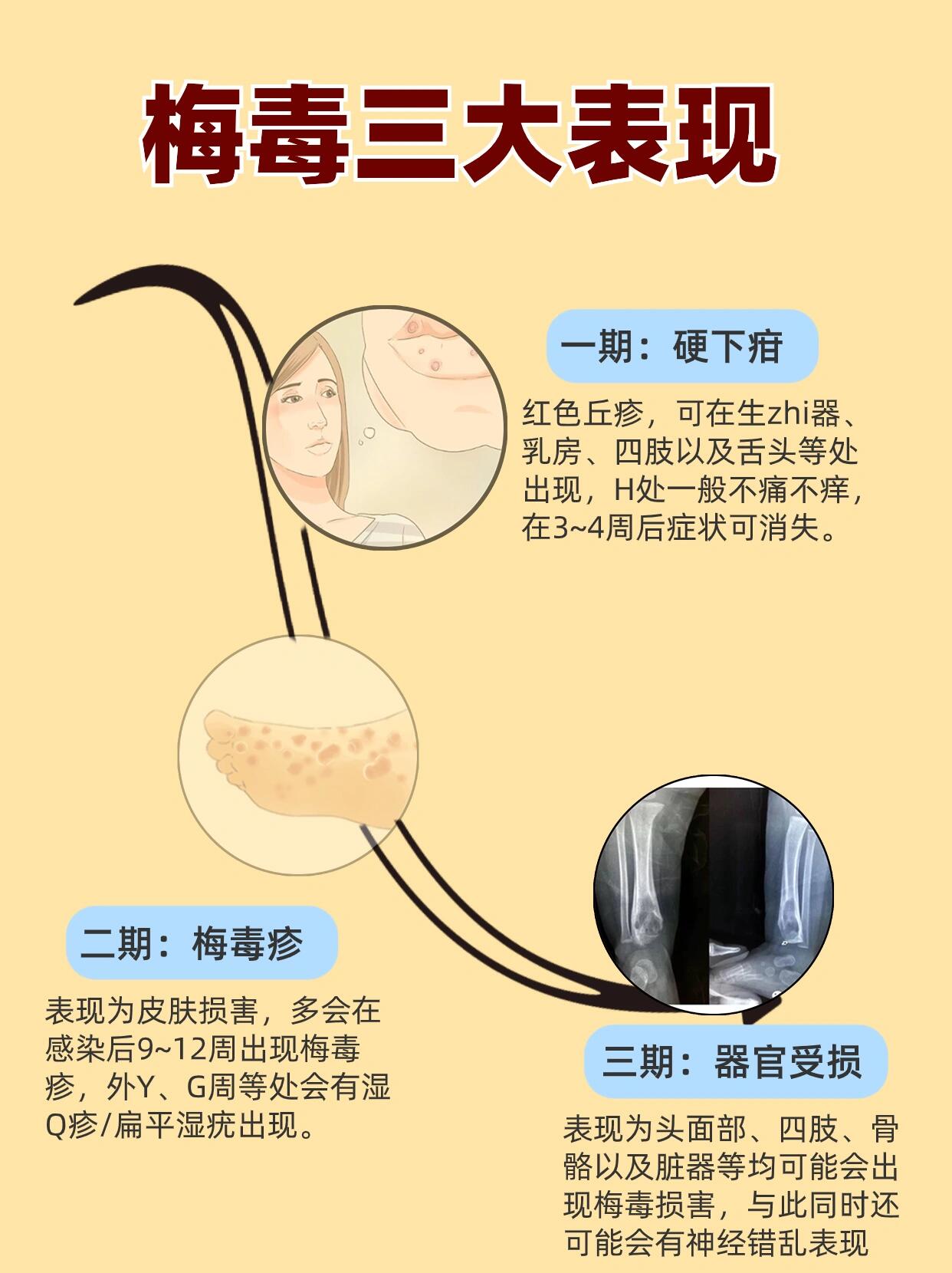 性病的特征是什么