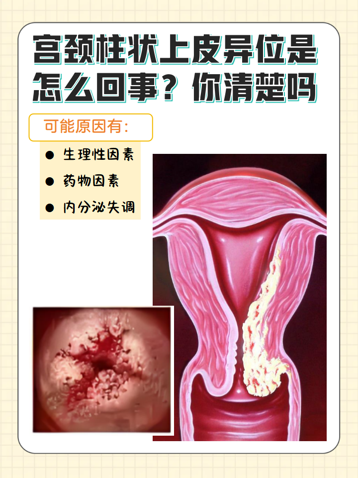 什么叫做宫颈糜烂