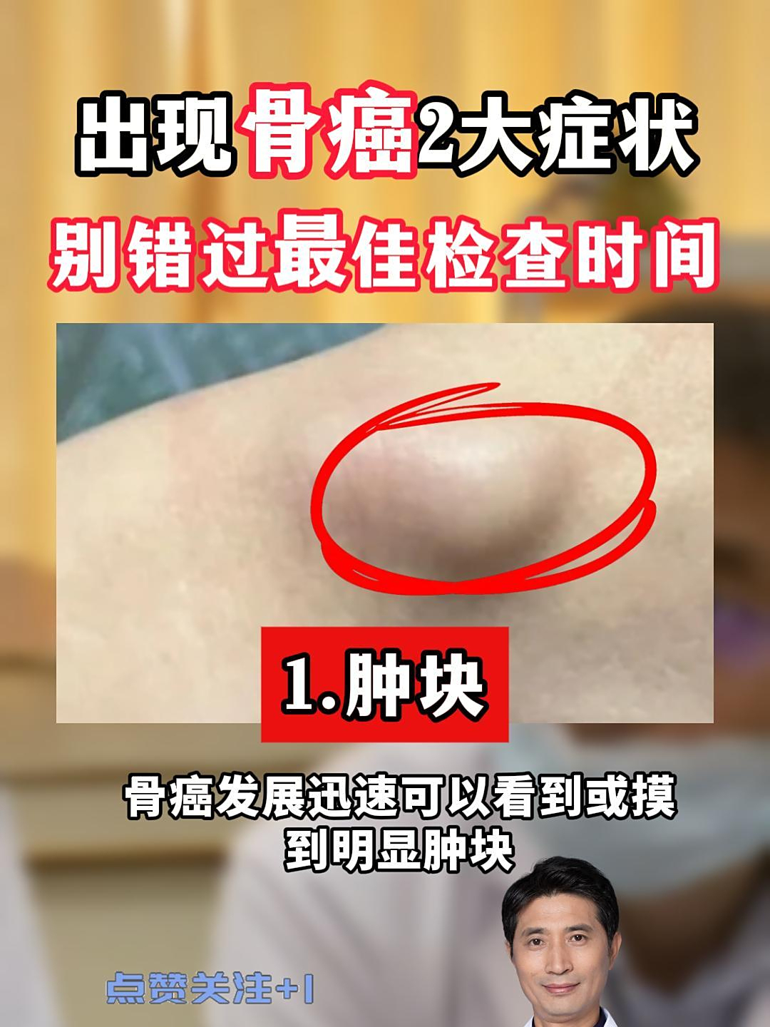 骨瘤早期没有任何症状吗?