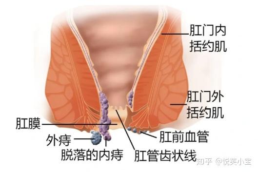 痔疮出血怎么治疗