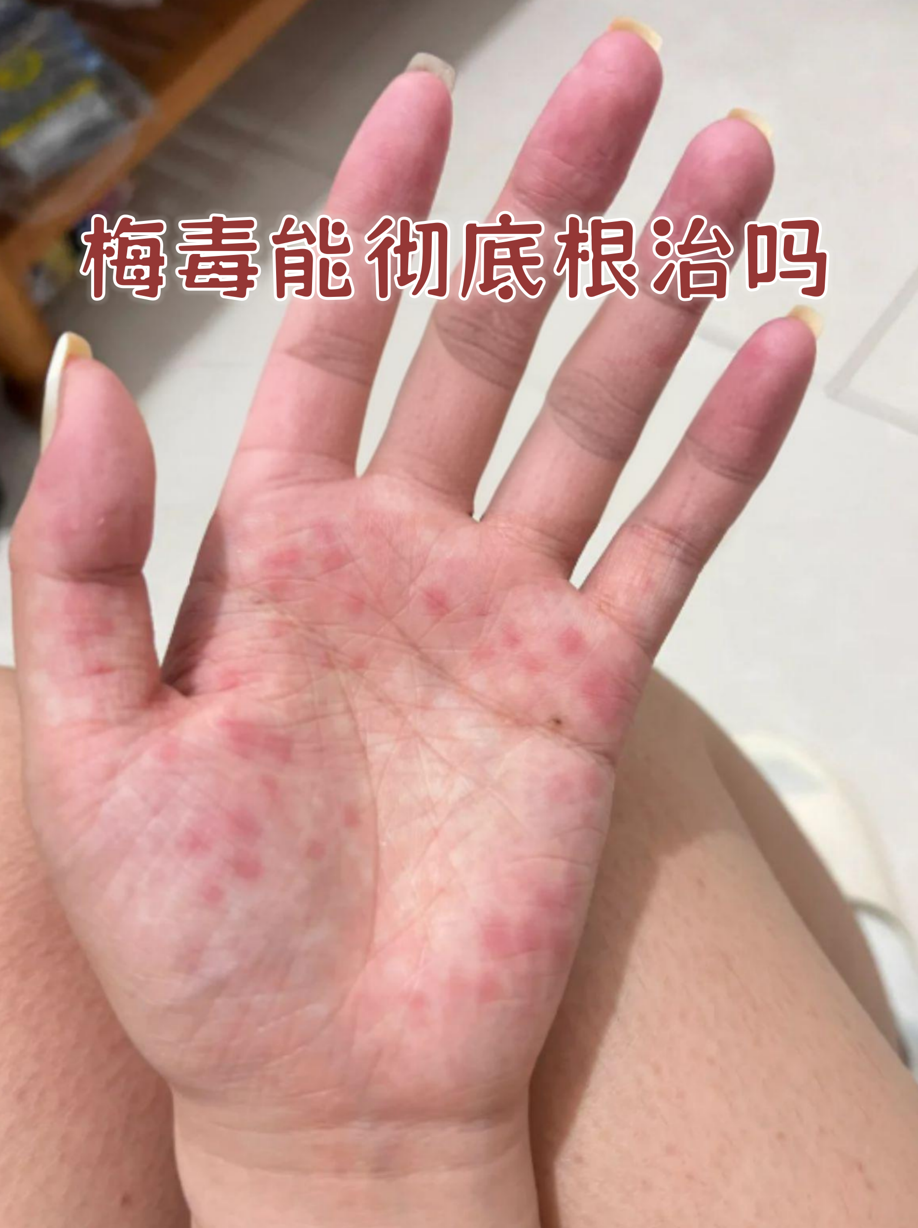 梅毒可以治愈吗