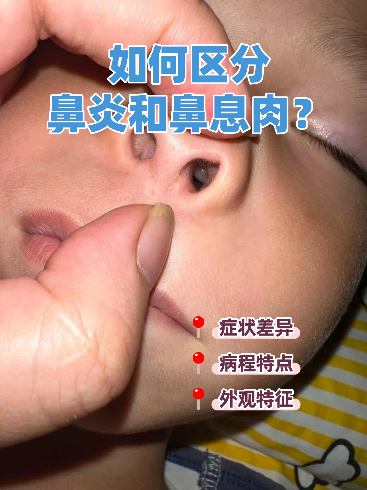 鼻炎和鼻窦炎的区别有哪些