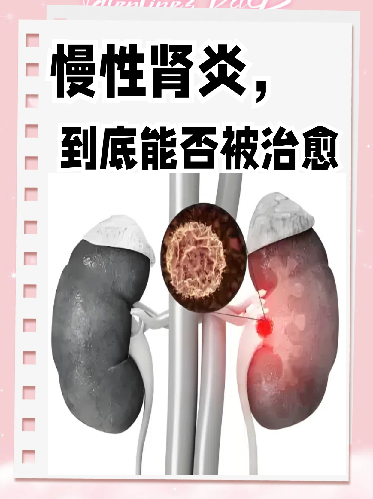 慢性肾炎的症状有哪些?