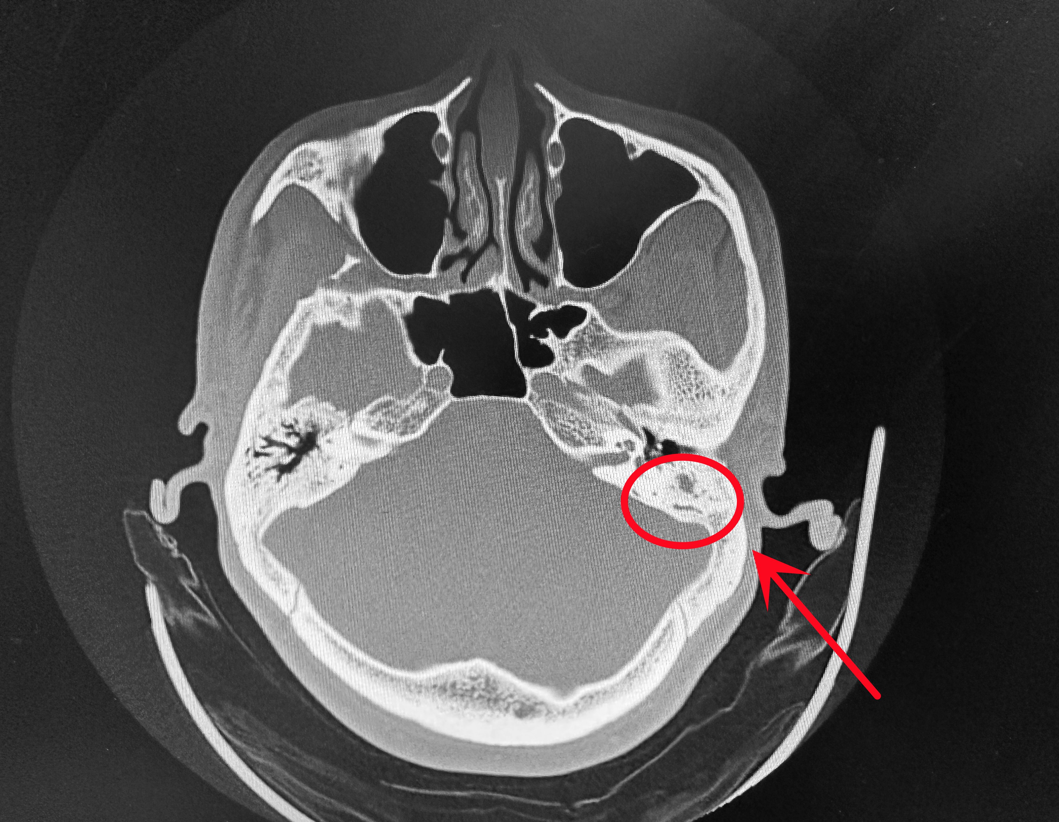 什么是中耳胆脂瘤?