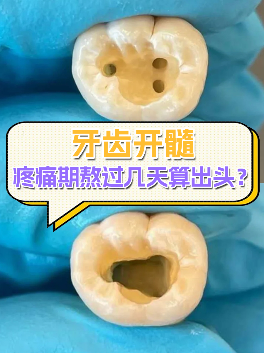 根管治疗需要多久时间?