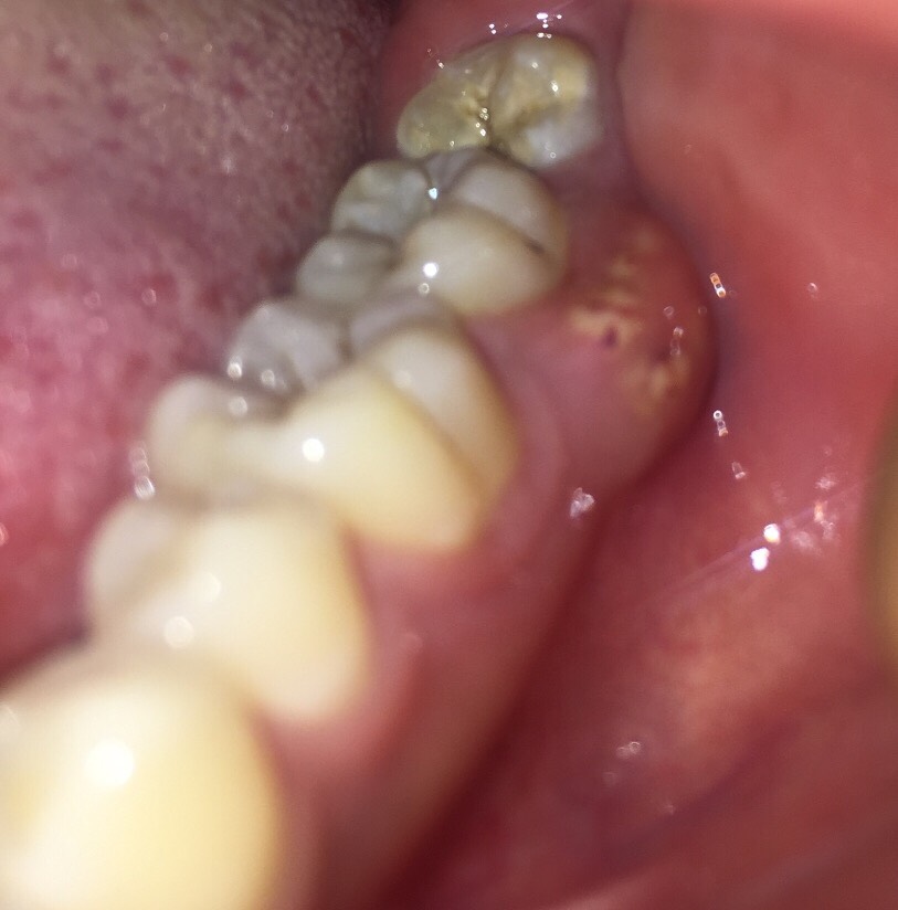 牙龈经常发炎红肿有脓包