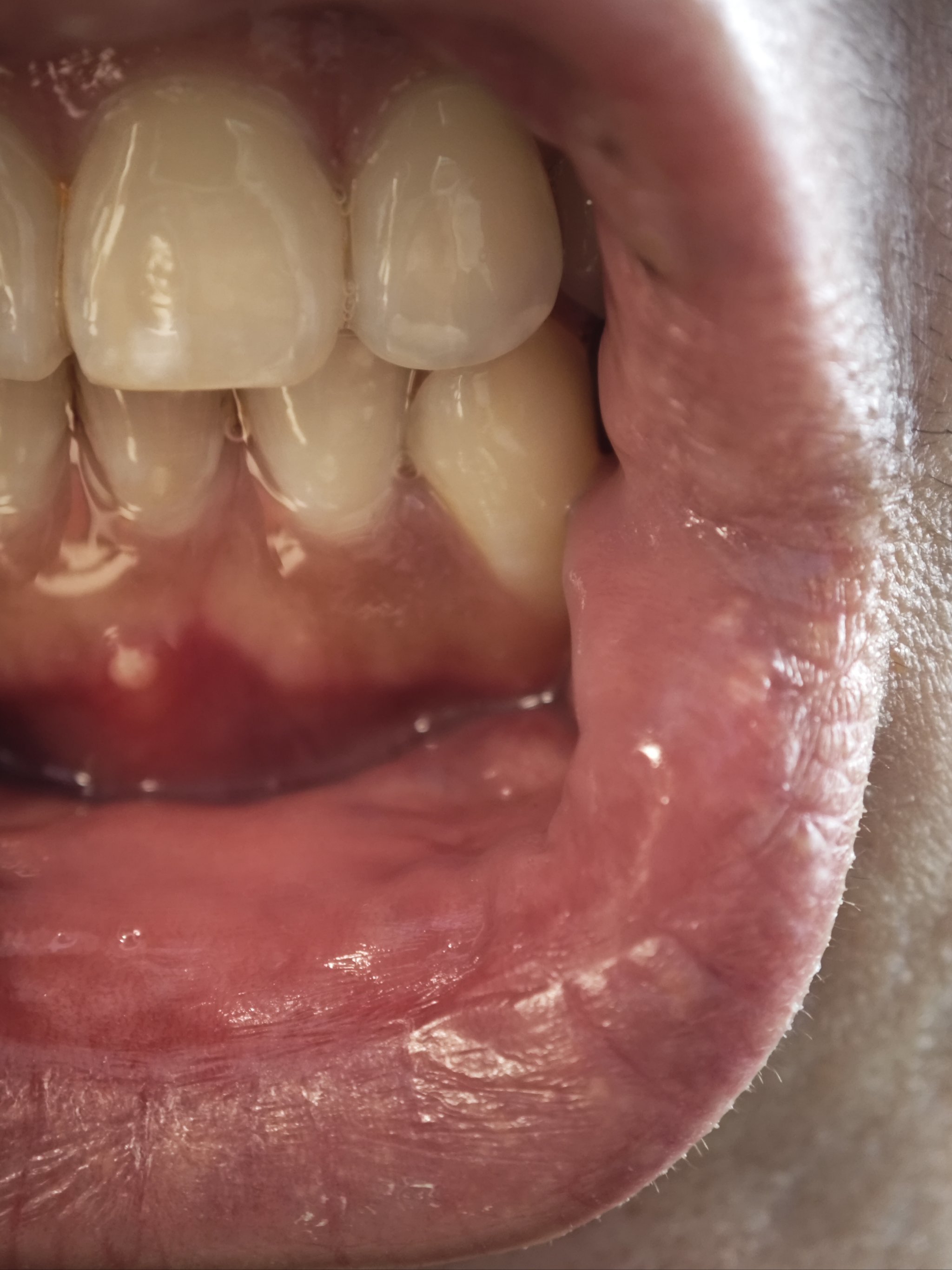 牙龈经常发炎红肿有脓包