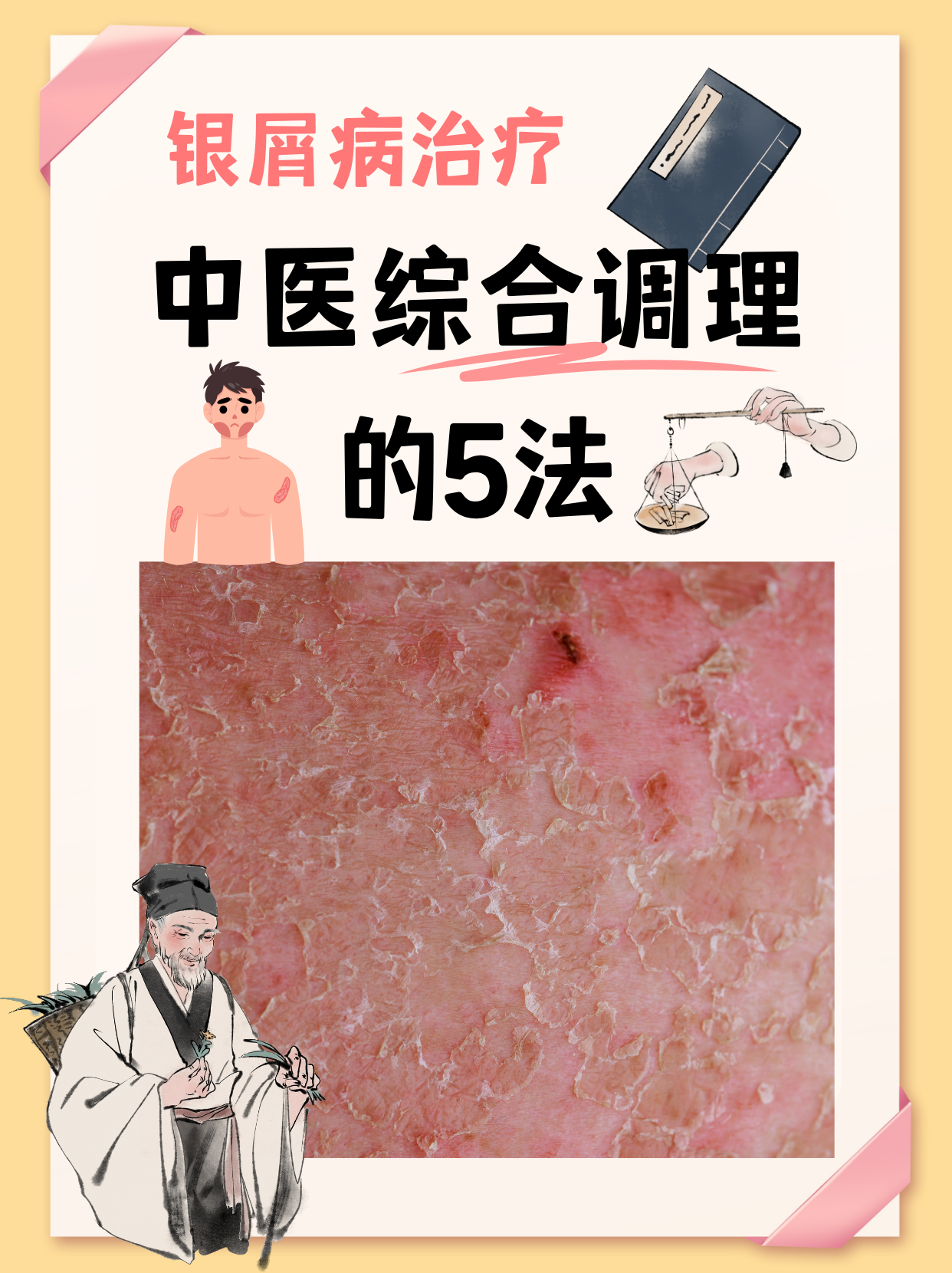 牛皮癣可以治好吗?