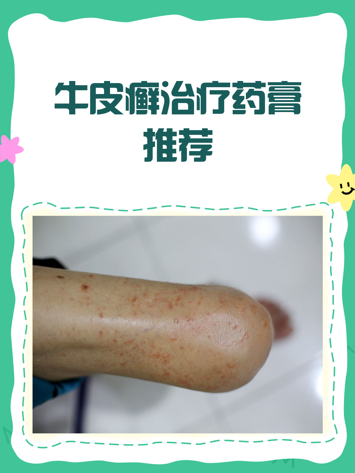 牛皮癣可以治好吗?