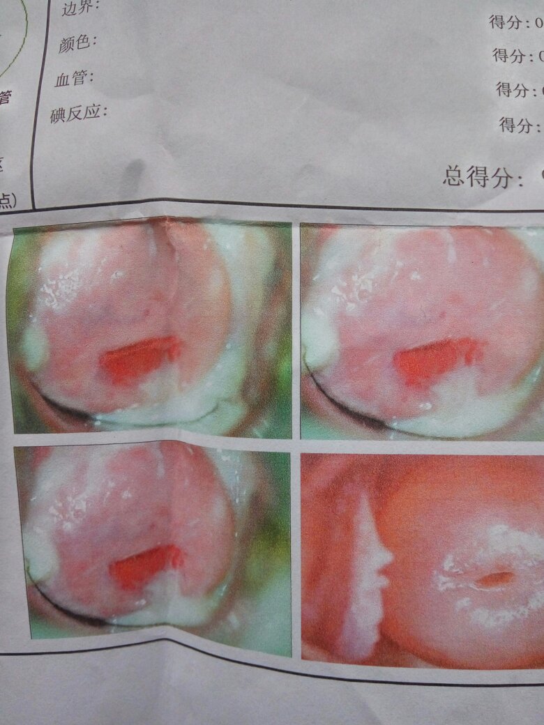 宫颈糜烂的症状表现