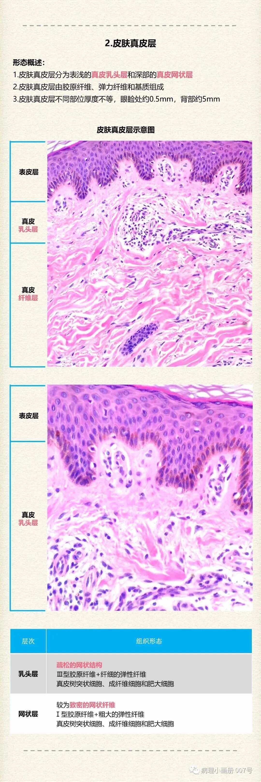 什么是盘状红斑狼疮