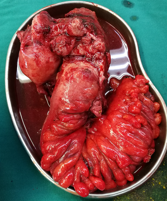 卵巢癌手术后能活多久