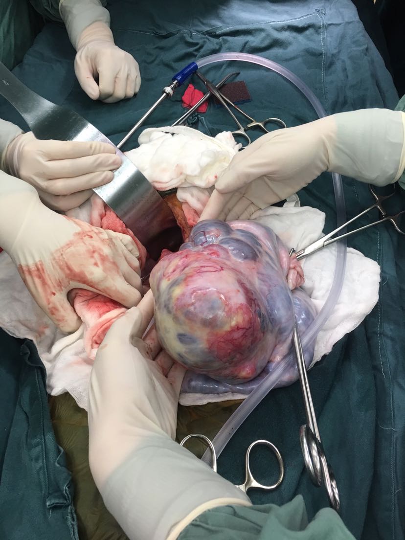 卵巢癌手术后能活多久