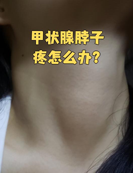 亚急性甲状腺炎是什么东西