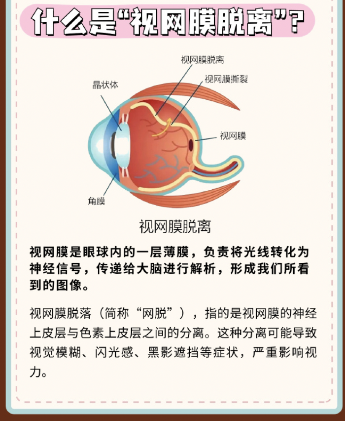 视网膜脱落症状有哪些