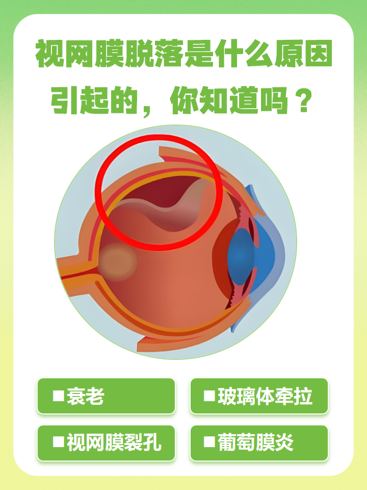 视网膜脱落症状有哪些