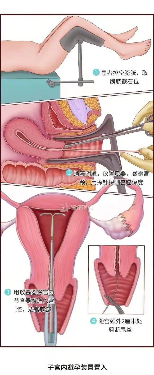 女人结扎还能生吗
