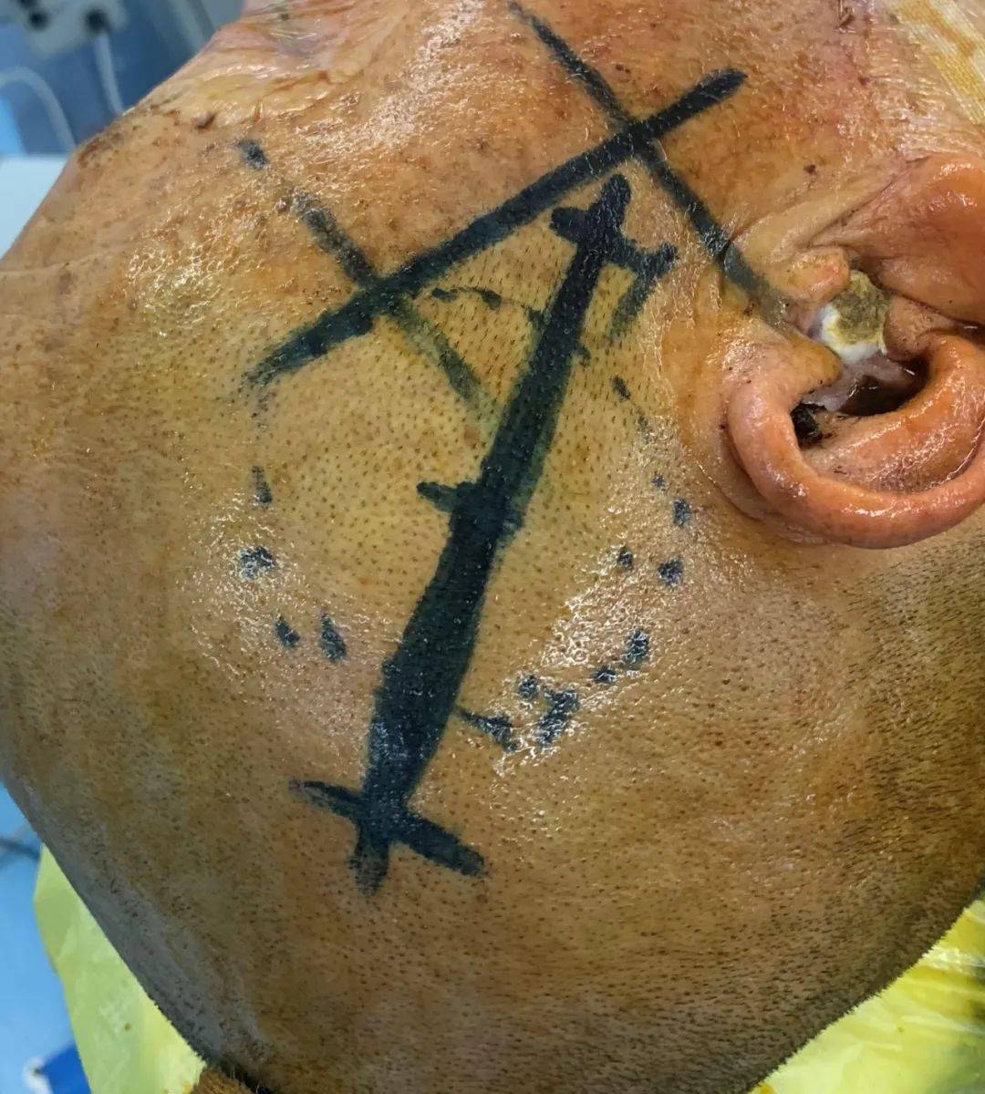 脑出血后抽搐会死人吗