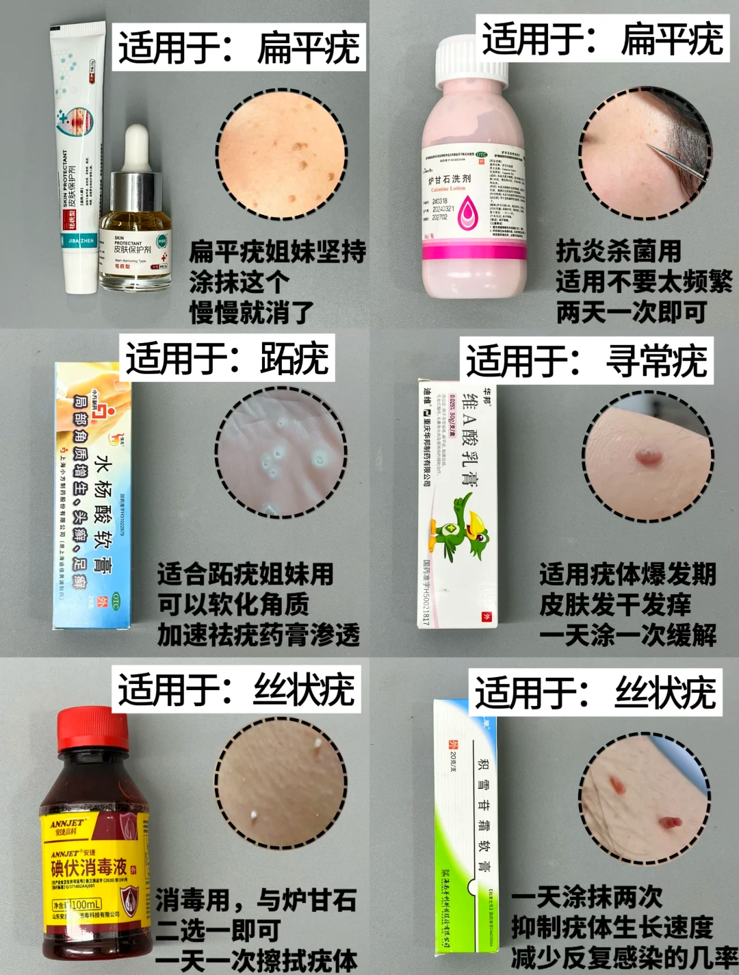 扁平疣治疗偏方