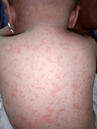 婴幼儿出疹子的症状.