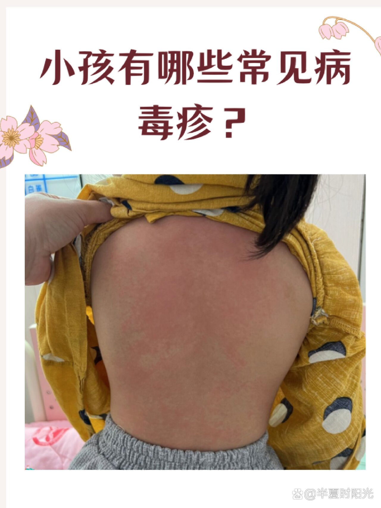 婴幼儿出疹子的症状.