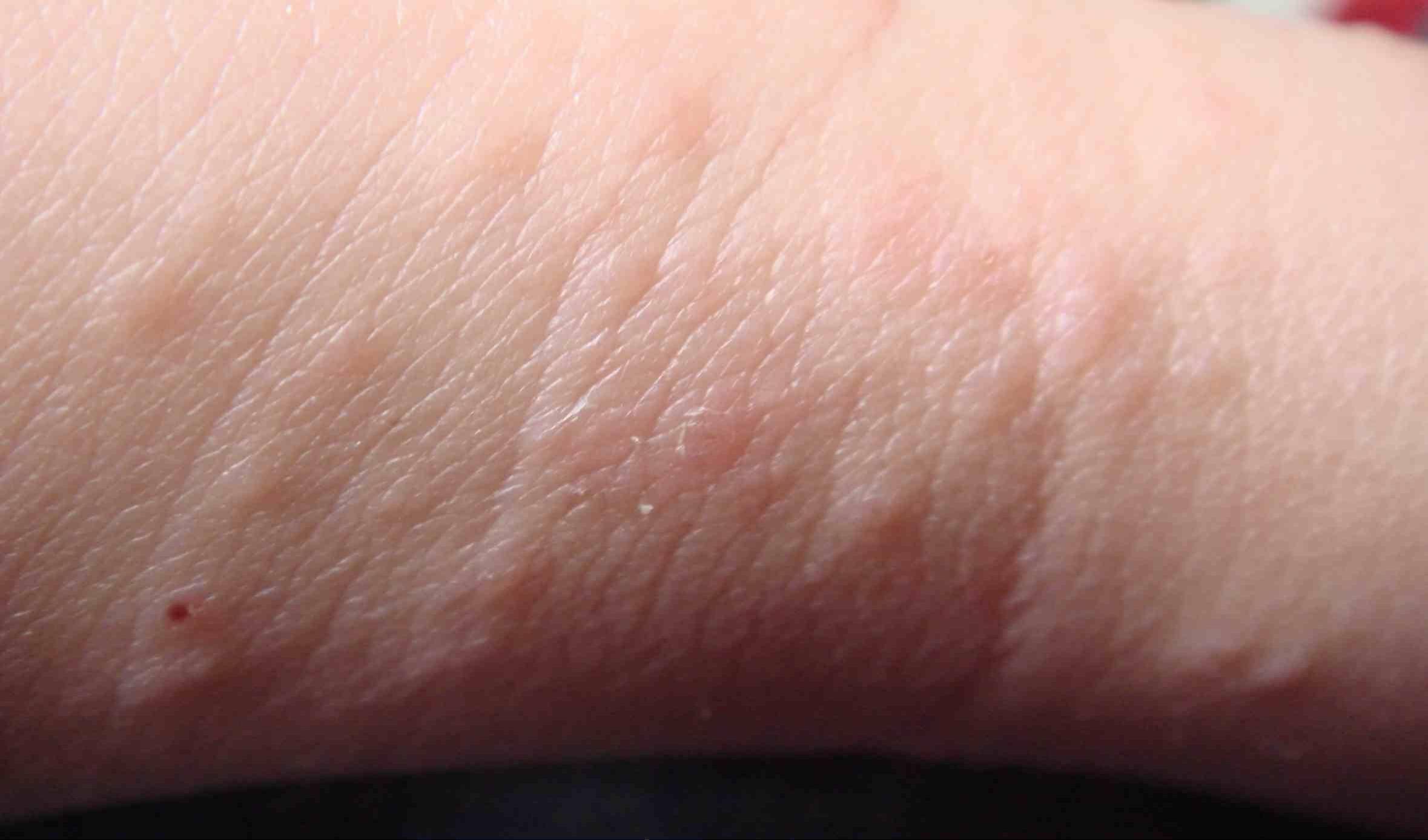 利多卡因的过敏症状有哪些