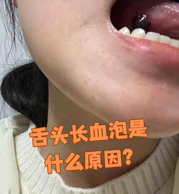 舌根起泡是怎么回事