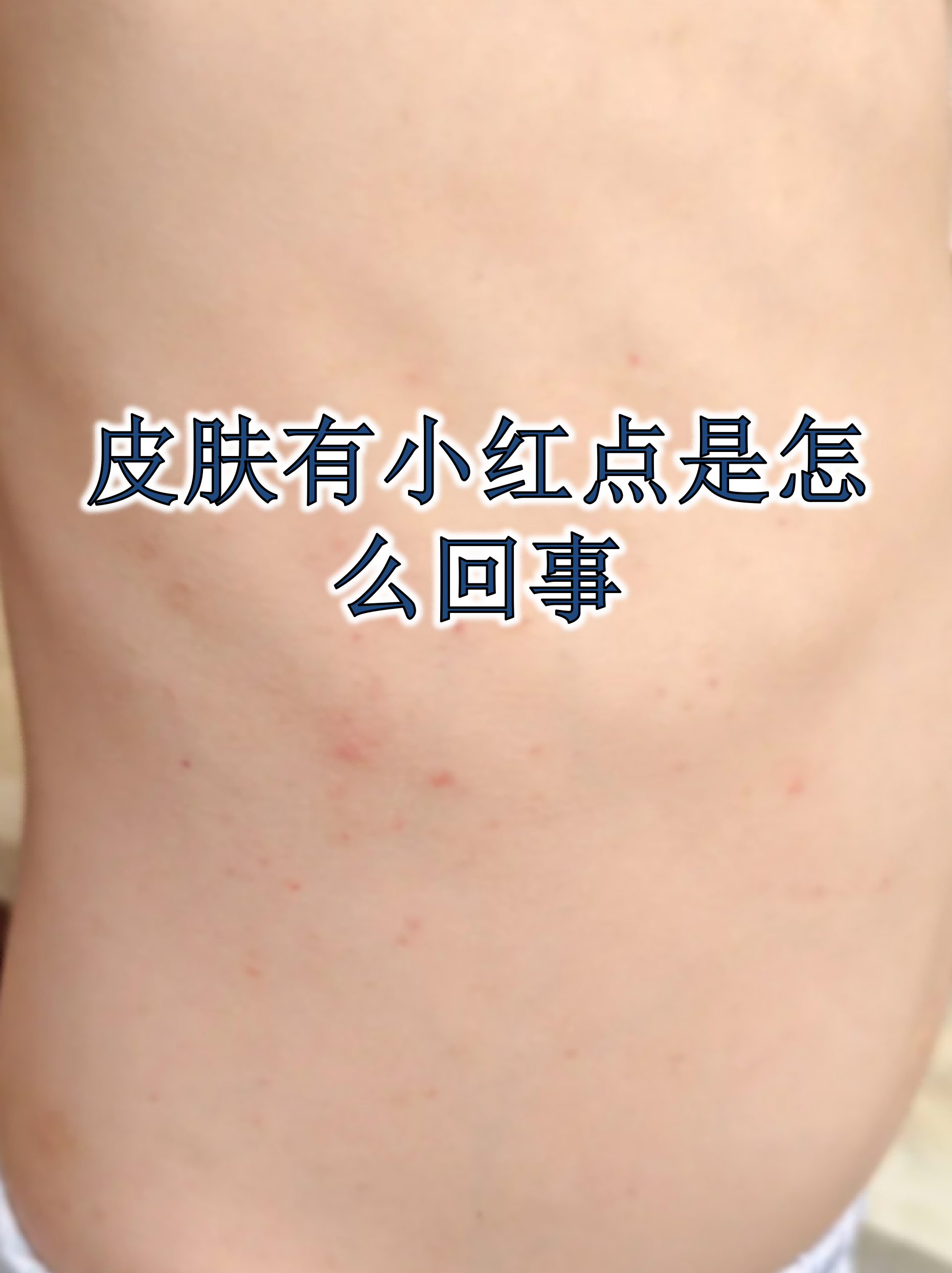 虫咬皮炎是怎样的