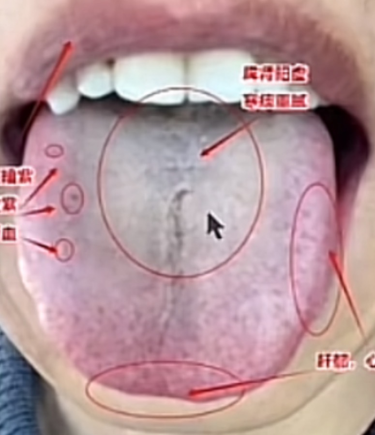 舌头出血是肝癌的征兆