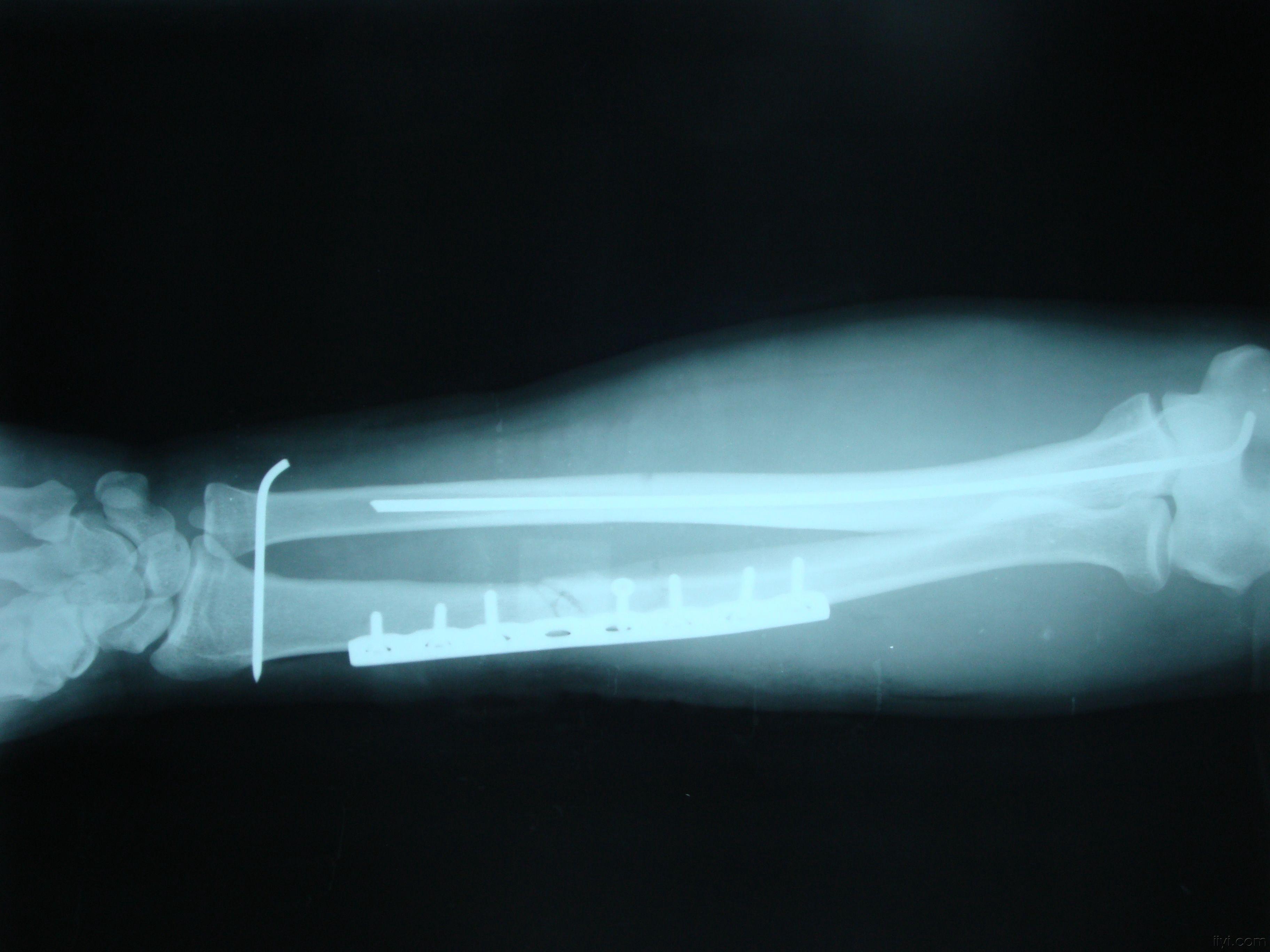 什么是盖氏骨折