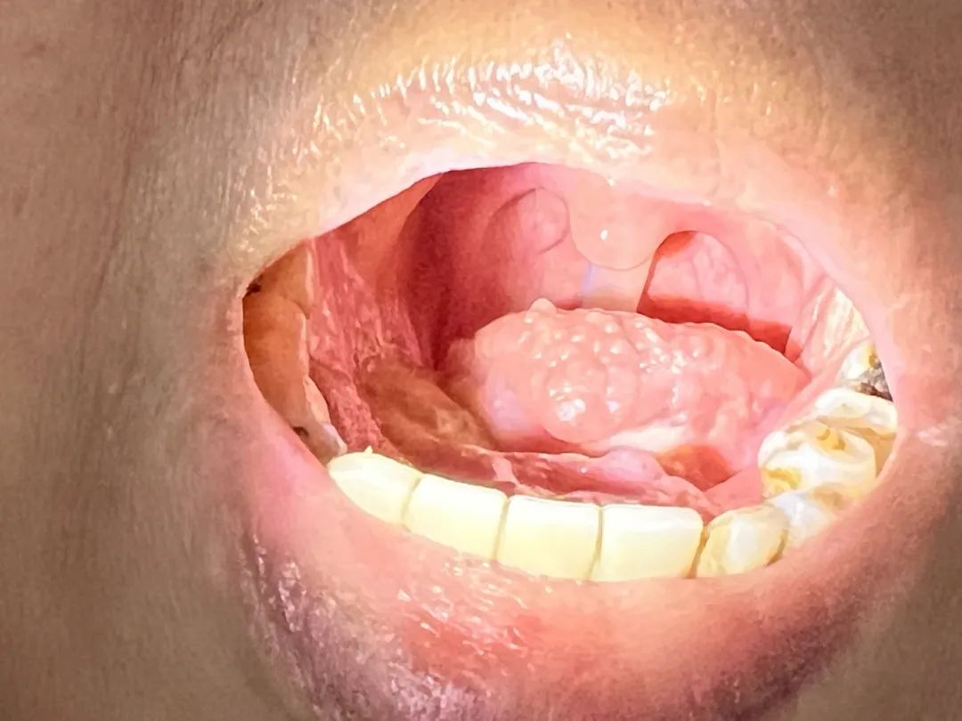 舌根癌有哪些症状